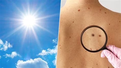 raios-UV-80-por-cento-dos-casos-de-melanoma.jpg